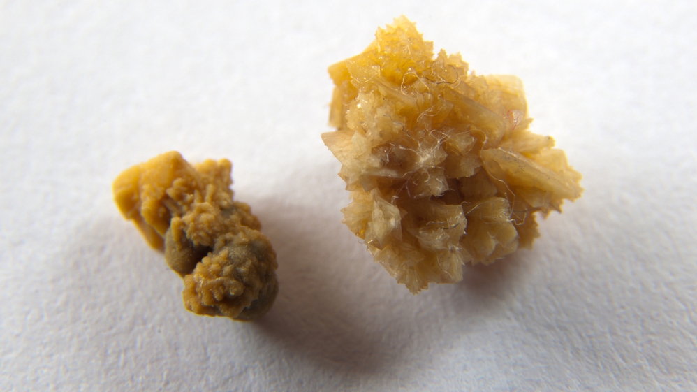 Kidney Stone Example