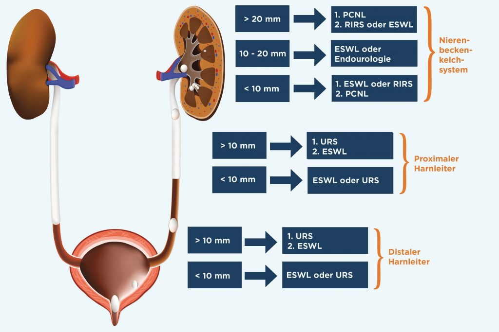 Kidney Stones Patient Center — Dornier MedTech